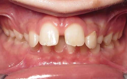 More smile transformations 8 Jfo smile gallery aidan center smile start