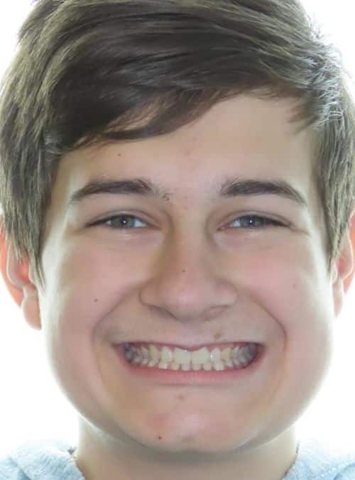 More smile transformations 7 Jfo smile gallery aidan full face smile finish