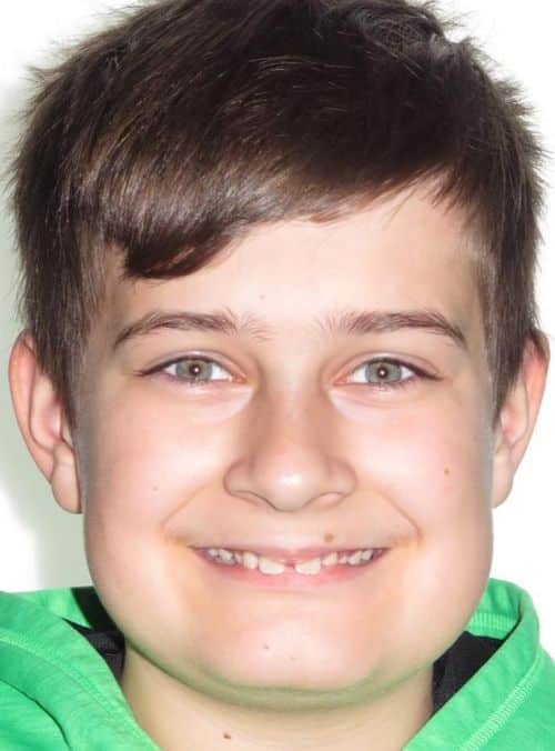 More smile transformations 6 Jfo smile gallery aidan full face smile start