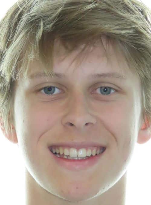 Smile gallery 241 Jfo smile gallery noah full face smile after