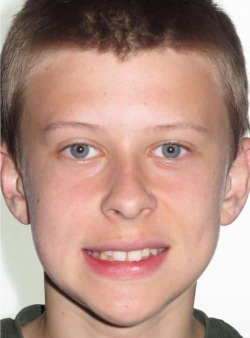 Smile gallery 240 Jfo smile gallery noah full face smile before