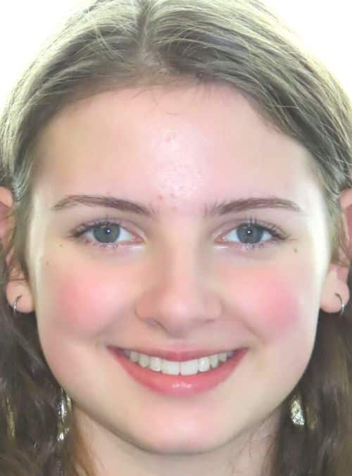 More smile transformations 5 Jfo smile gallery sarah full face smile after