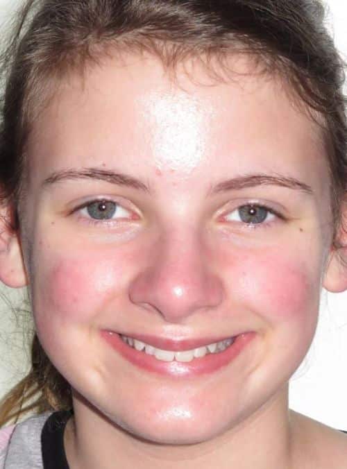 More smile transformations 4 Jfo smile gallery sarah full face smile before
