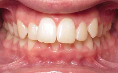 More smile transformations 2 Jfo smile gallery sarah center smile before