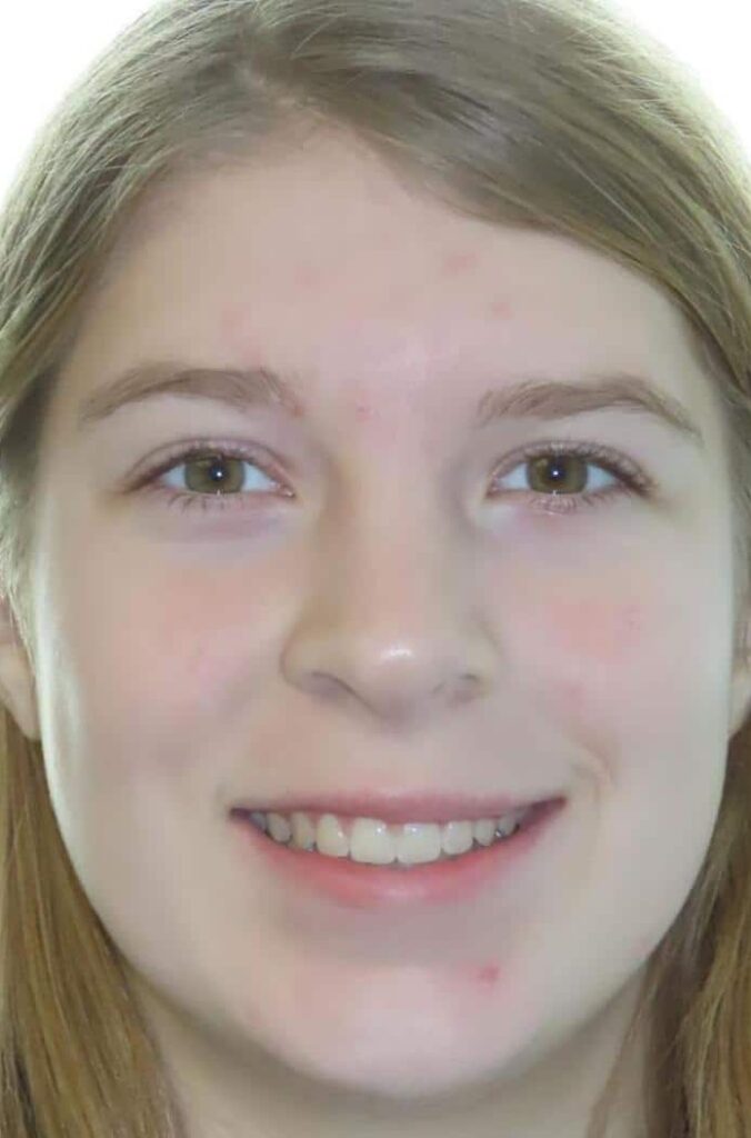 Smile gallery 223 Katelyn a finish smile