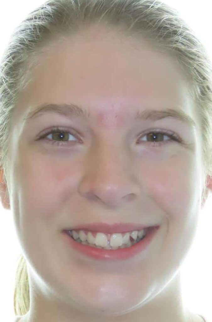 Smile gallery 222 Katelyn a start smile
