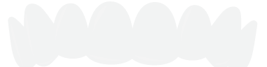 Vacuform retainer Vacuform retainer illustration