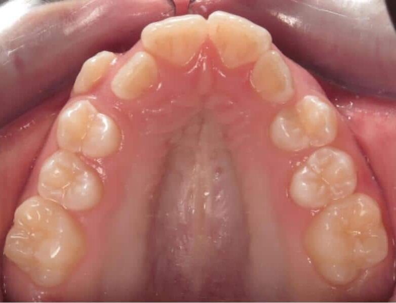Smile gallery 202 Isla u occlusal start