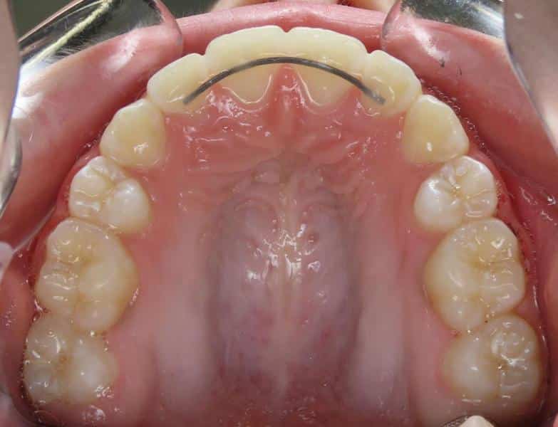 Smile gallery 203 Isla u occlusal final