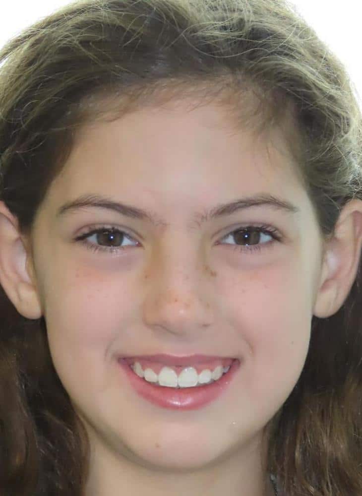 Smile gallery 199 Isla 2 smile final