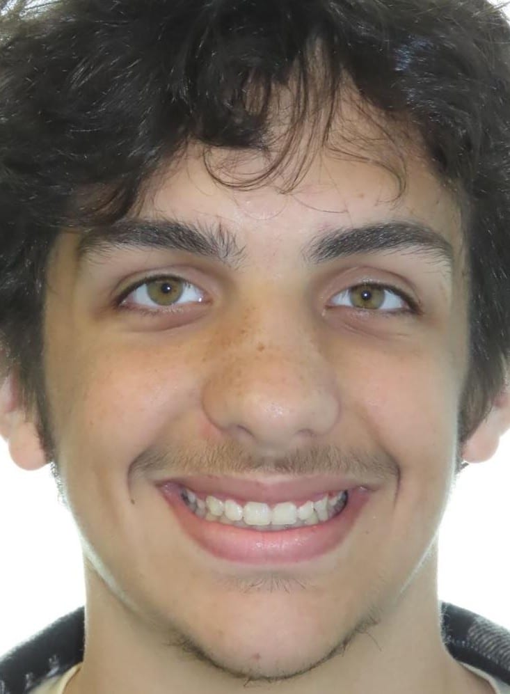 Smile gallery 183 Ethan smile final photo smile transformation joosse family orthodontics