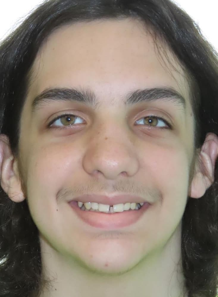 Smile gallery 182 Ethan smile start photo smile transformation joosse family orthodontics