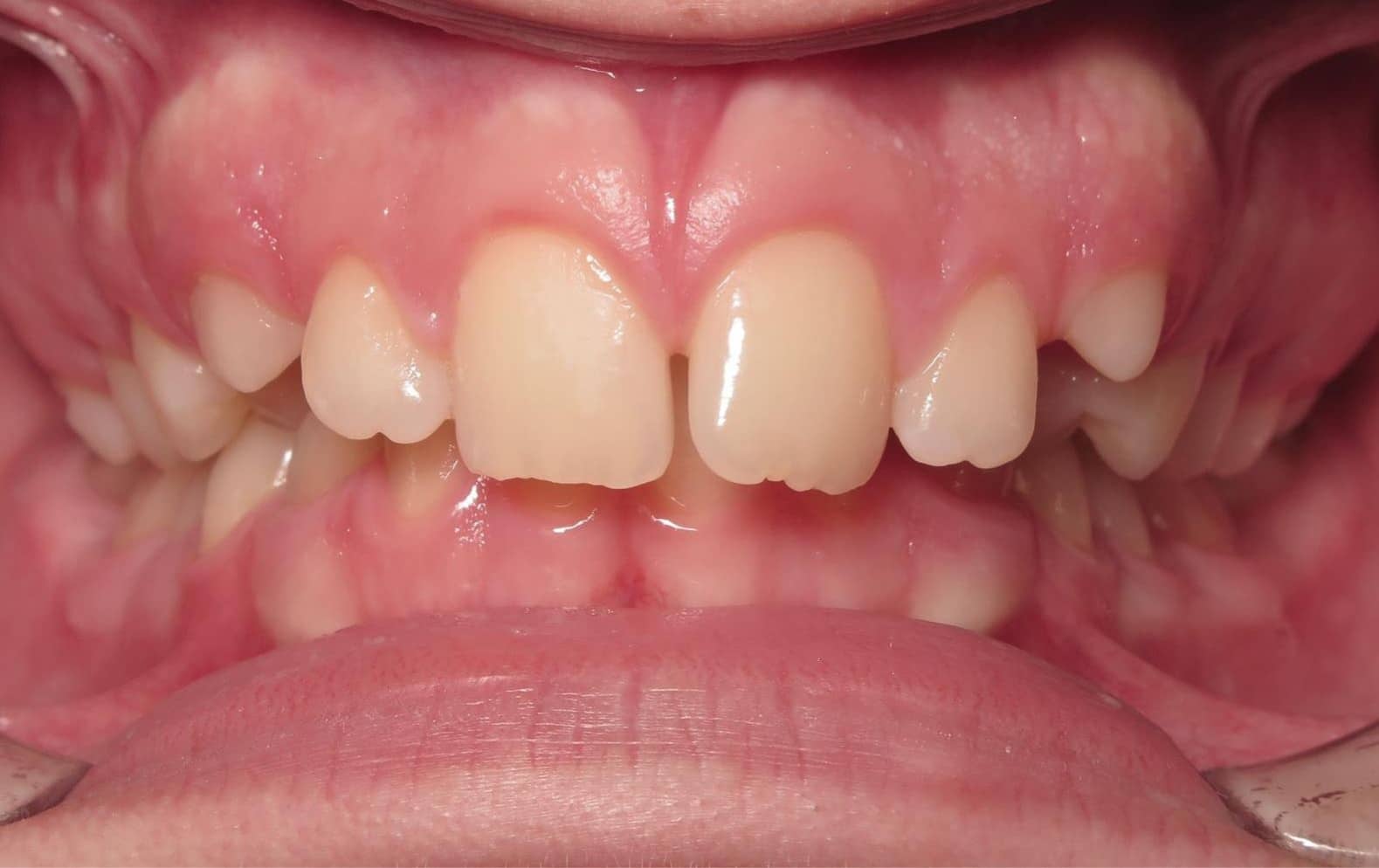 Smile gallery 178 Sawyer smile photo start smile transformation joosse family orthodontics