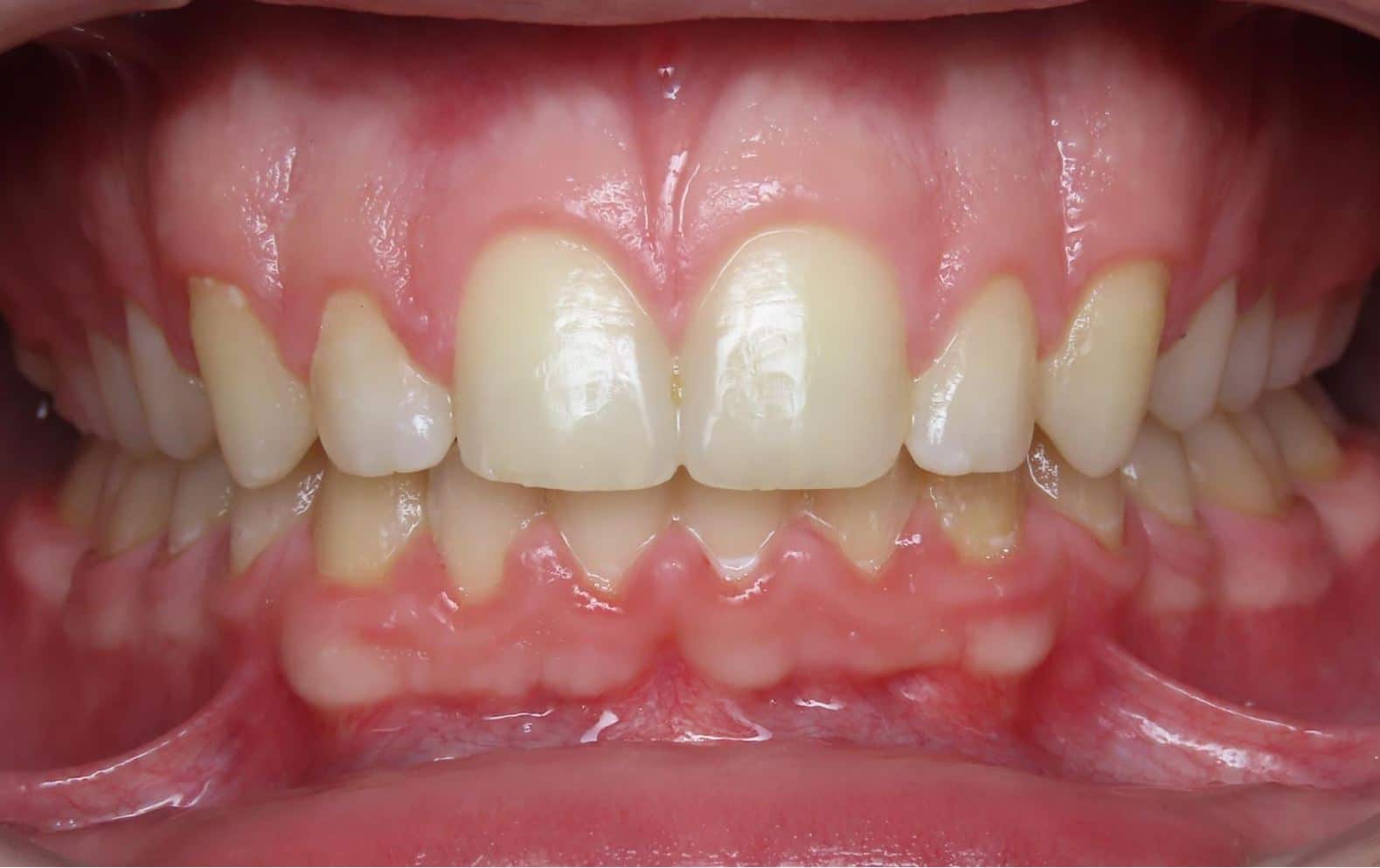 Smile gallery 179 Sawyer center photo final smile transformation joosse family orthodontics