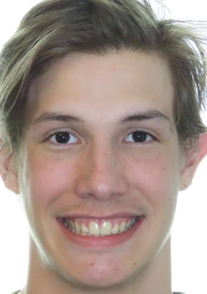 Smile gallery 181 Sawyer smile photo final smile transformation joosse family orthodontics