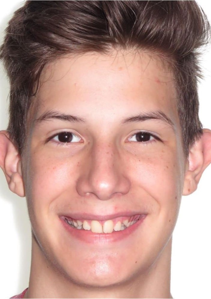 Smile gallery 180 Sawyer smile photo start smile transformation joosse family orthodontics