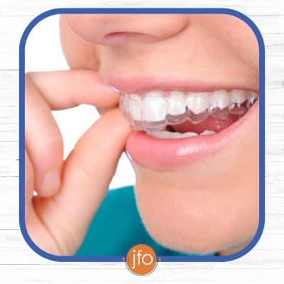 Transitioning to the retention phase 2 Clear aligner over teeth