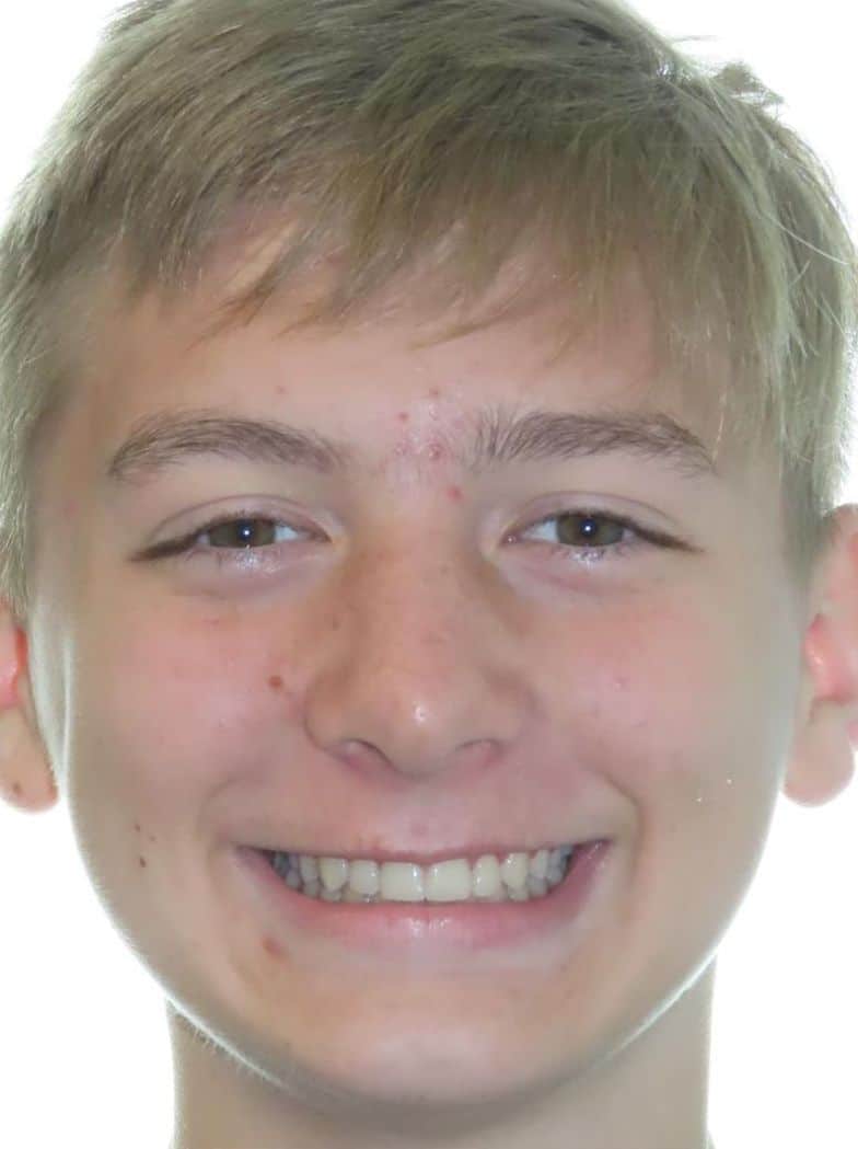 Smile gallery 173 Patient smiling new smile transformation orthodontic treatment results