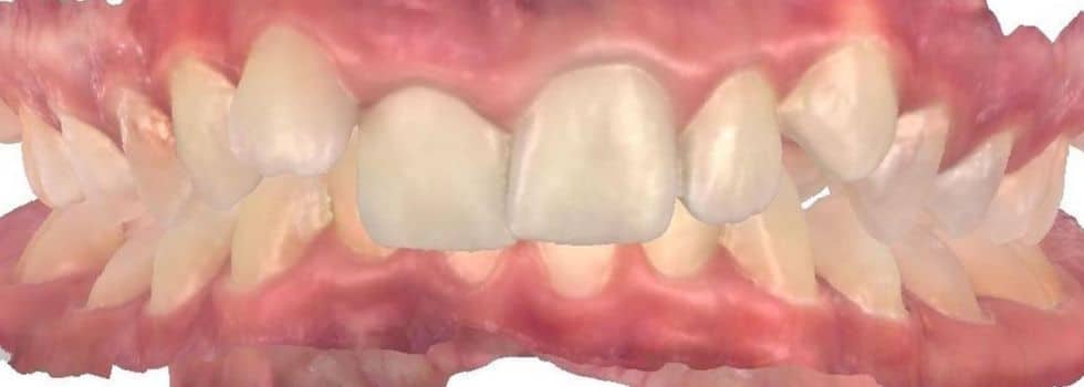 Smile gallery 170 Center teeth before treatment results smile transformation