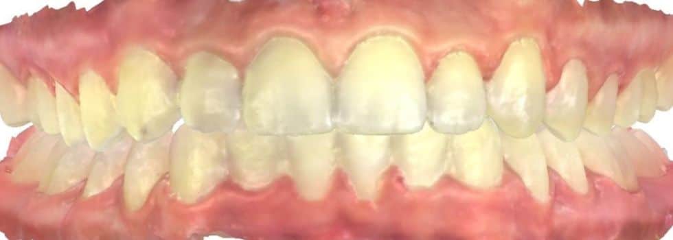 Smile gallery 171 Center teeth after results smile transformation