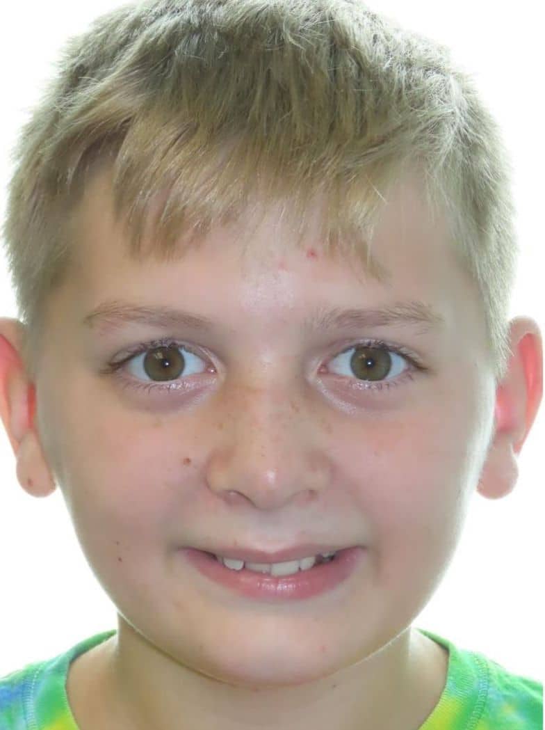 Smile gallery 172 Patient smiling before orthodontic treatment results