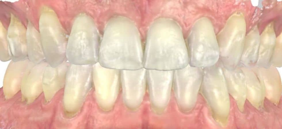 Smile gallery 169 Center teeth after results smile transformation