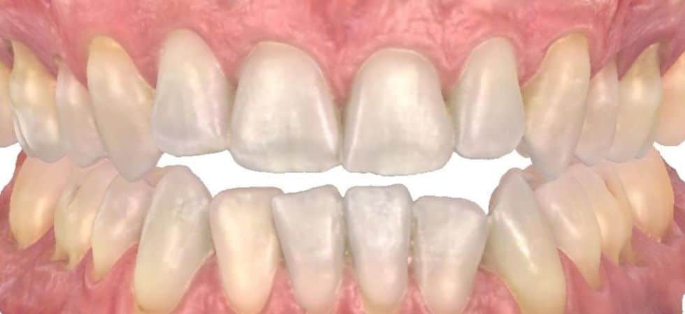 Smile gallery 168 Center teeth before treatment results smile transformation