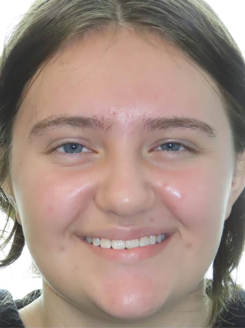 Smile gallery 175 Patient smiling new smile transformation orthodontic treatment results