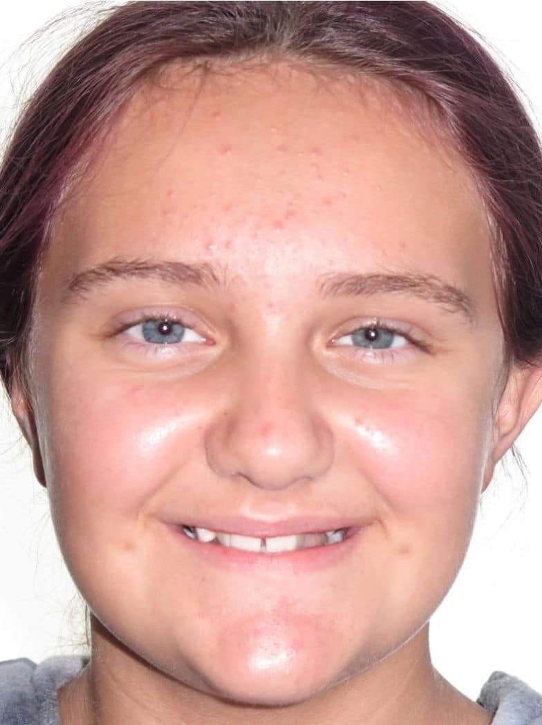 Smile gallery 174 Patient smiling before orthodontic treatment results