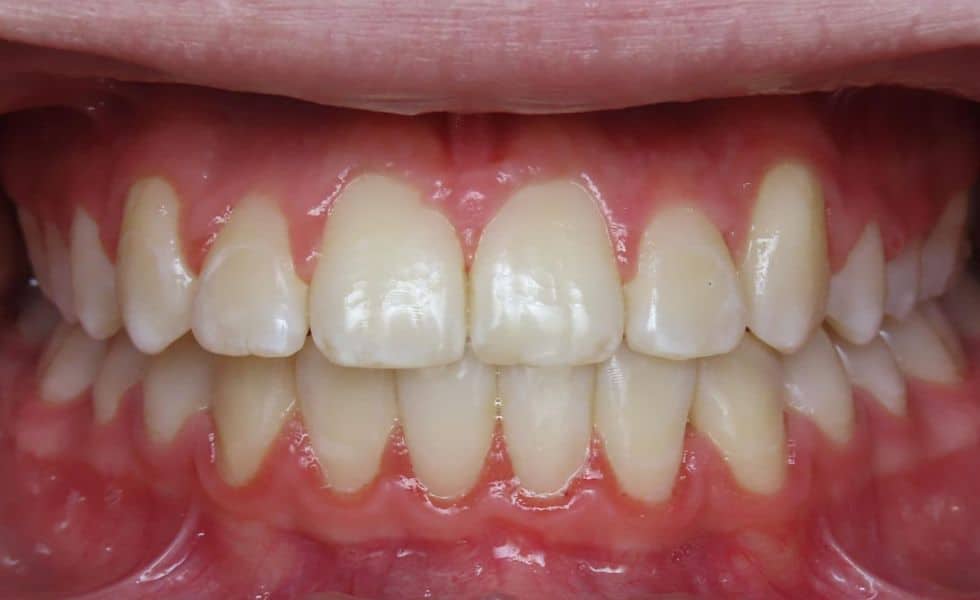 Smile gallery 177 Center teeth after results smile transformation