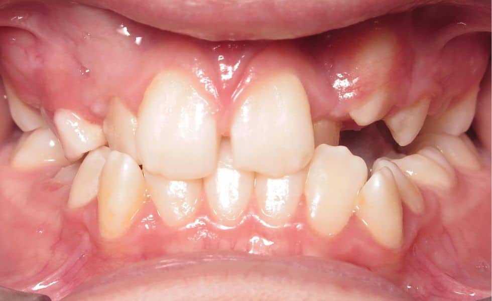 Smile gallery 176 Center teeth before treatment results smile transformation