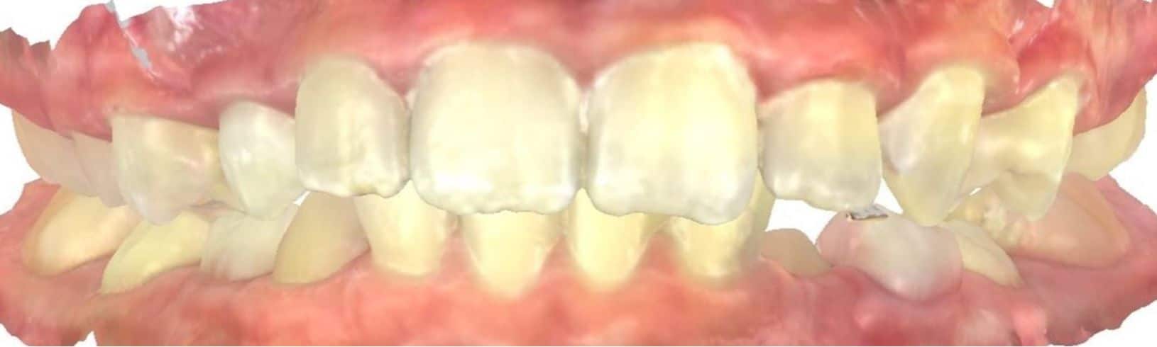 Smile gallery 159 Joosse patient center after treatment