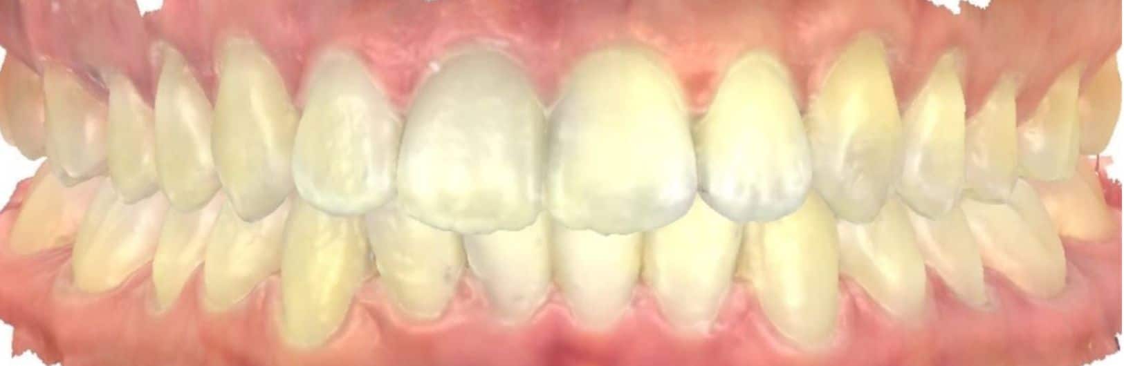 Smile gallery 163 Joosse patient center after treatment