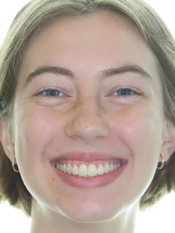 Smile gallery 165 Joosse patient smile after treatment