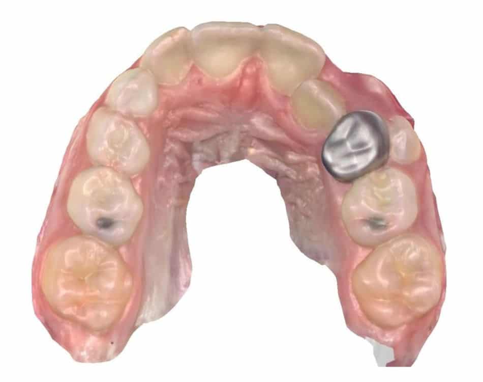 Smile gallery 160 Joosse patient occlusal before treatment