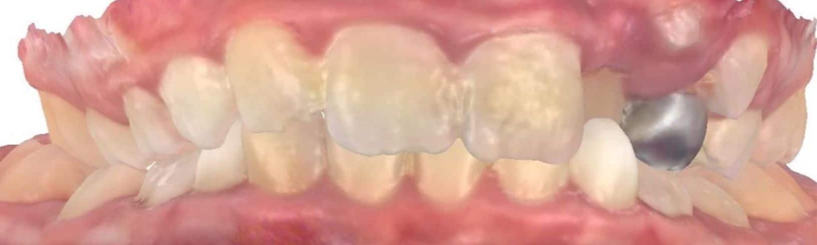 Smile gallery 158 Joosse patient center before treatment