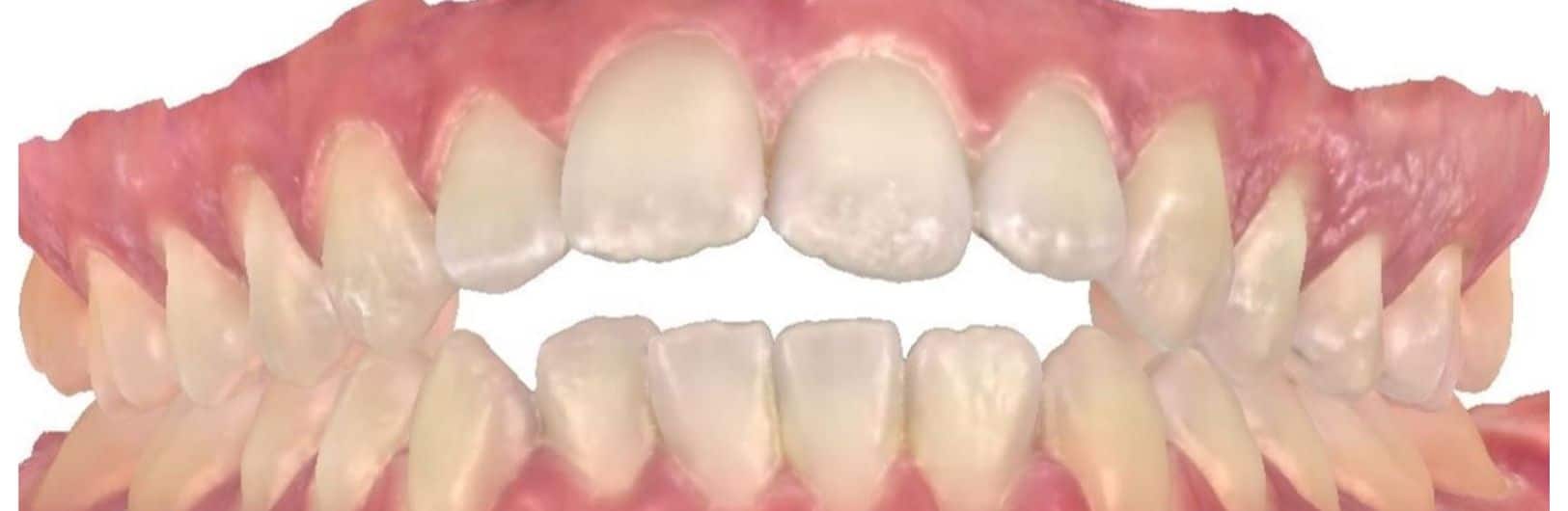 Smile gallery 162 Joosse patient center before treatment