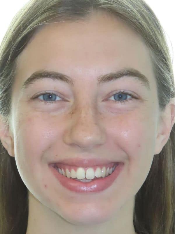 Smile gallery 164 Joosse patient smile before treatment