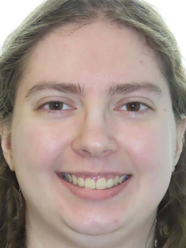 Smile gallery 155 After treatment patient smiling photo
