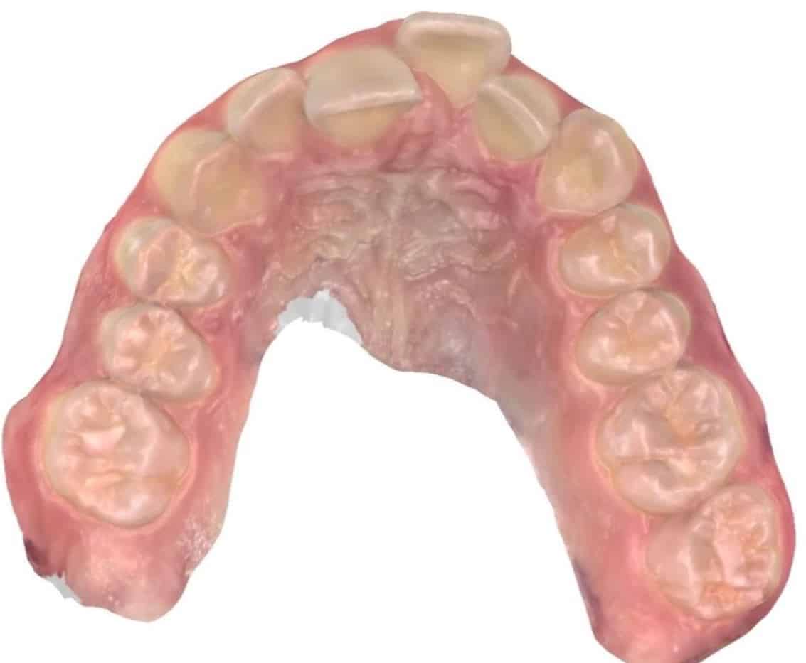 Smile gallery 152 Before orthodontic treatment results