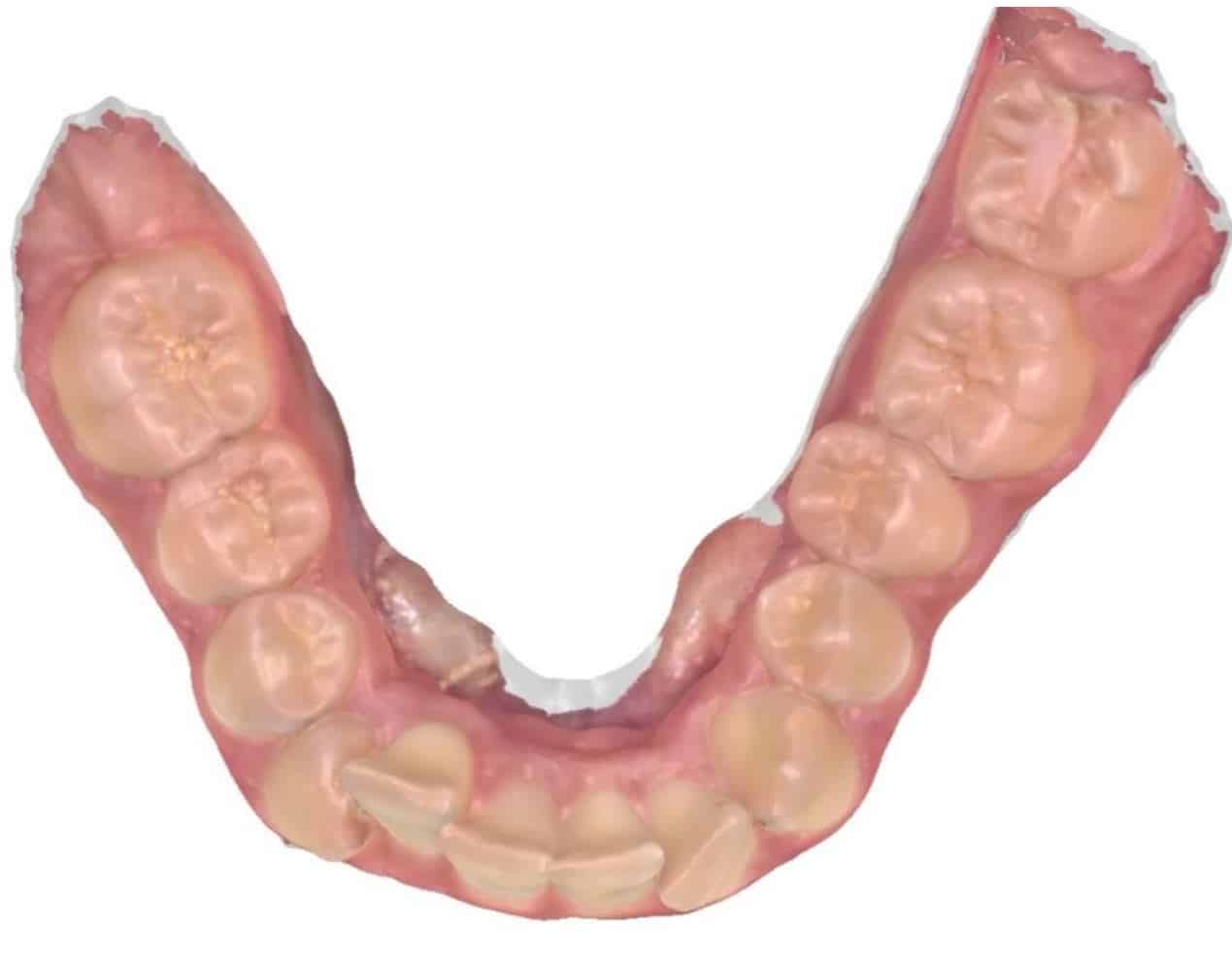 Smile gallery 148 Before orthodontic treatment results