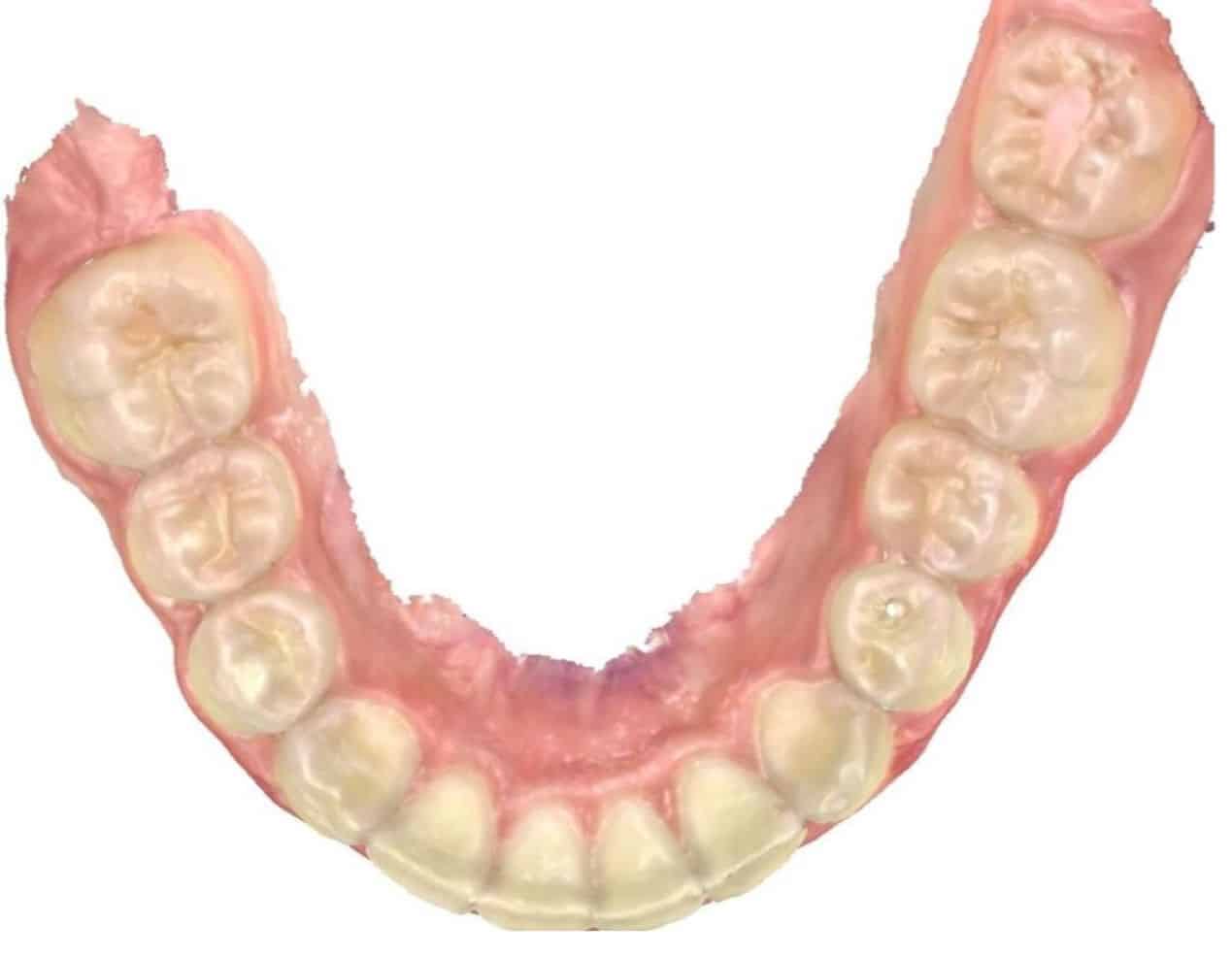 Smile gallery 149 Scan of teeth for invisalign treatment