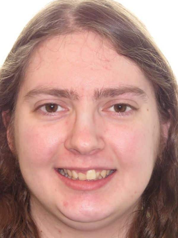 Smile gallery 154 Before treatment patient smiling photo