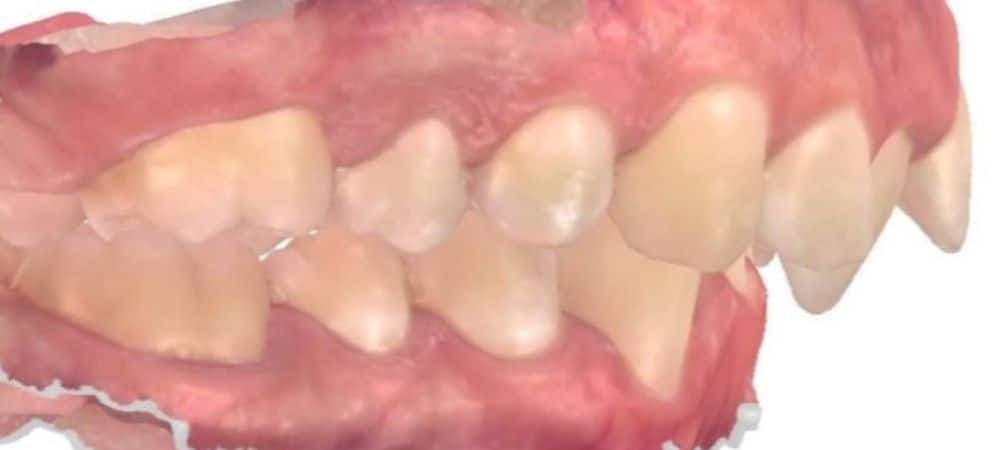 Smile gallery 146 Before orthodontic treatment results