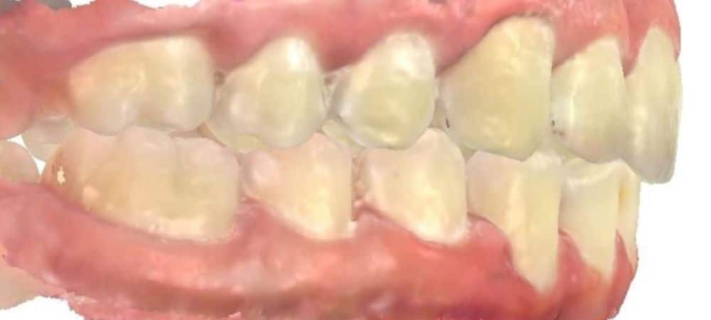 Smile gallery 147 After orthodontic treatment results
