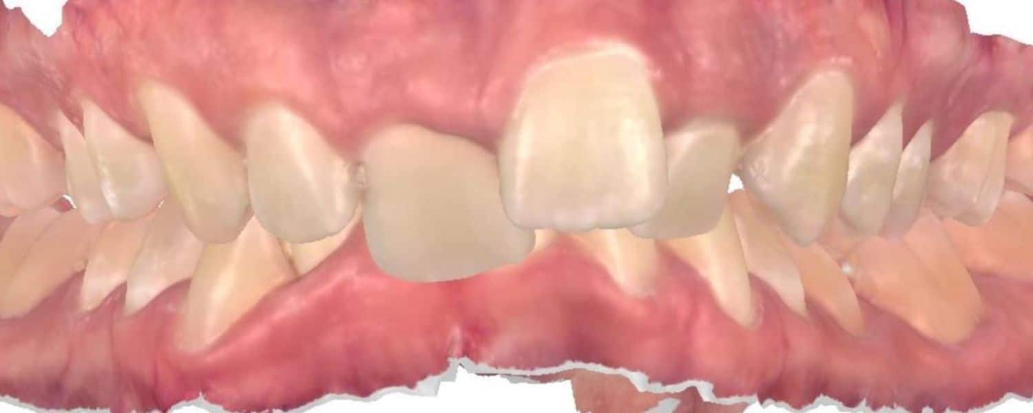 Smile gallery 150 Before orthodontic treatment results