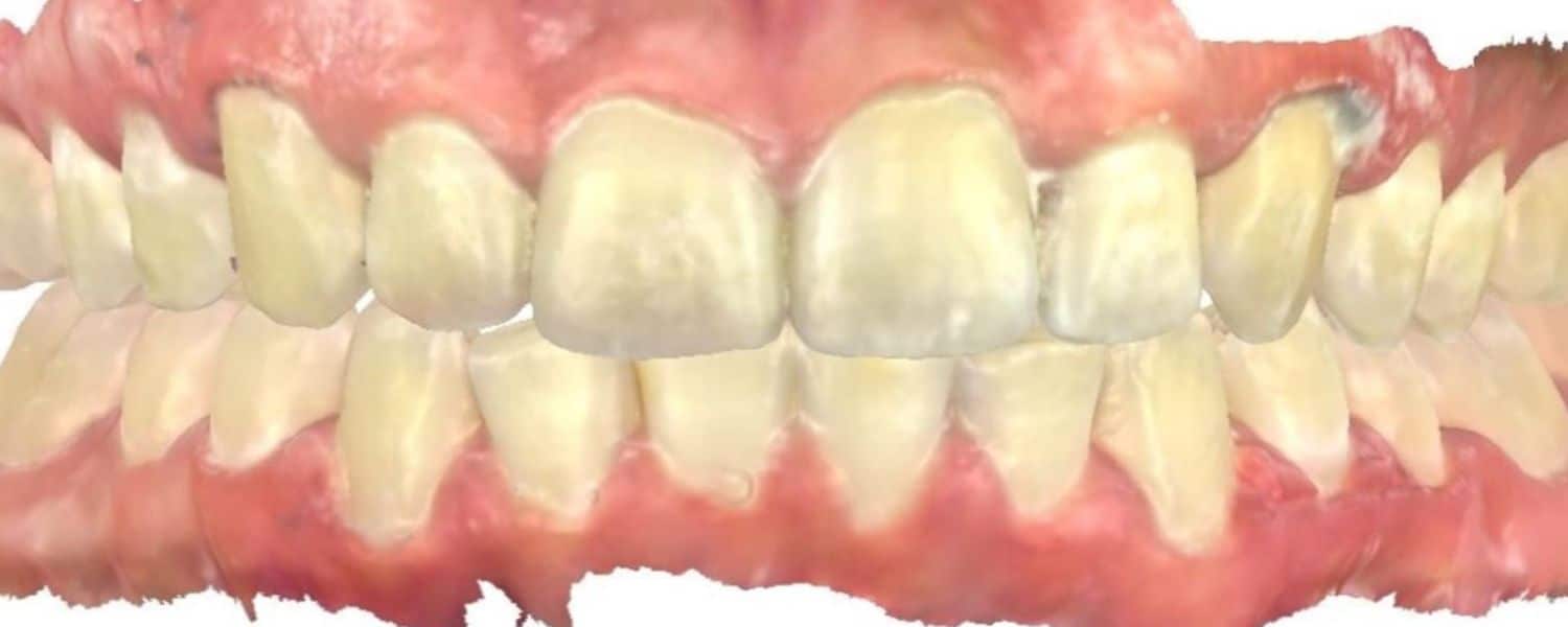 Smile gallery 151 After orthodontic treatment results