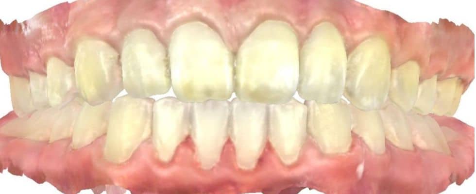 Smile gallery 145 C. S. Front teeth view center after treatment final results