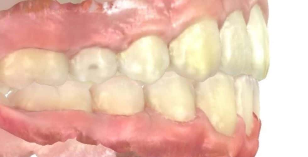 Smile gallery 143 C. S. Buccal final view results treatment