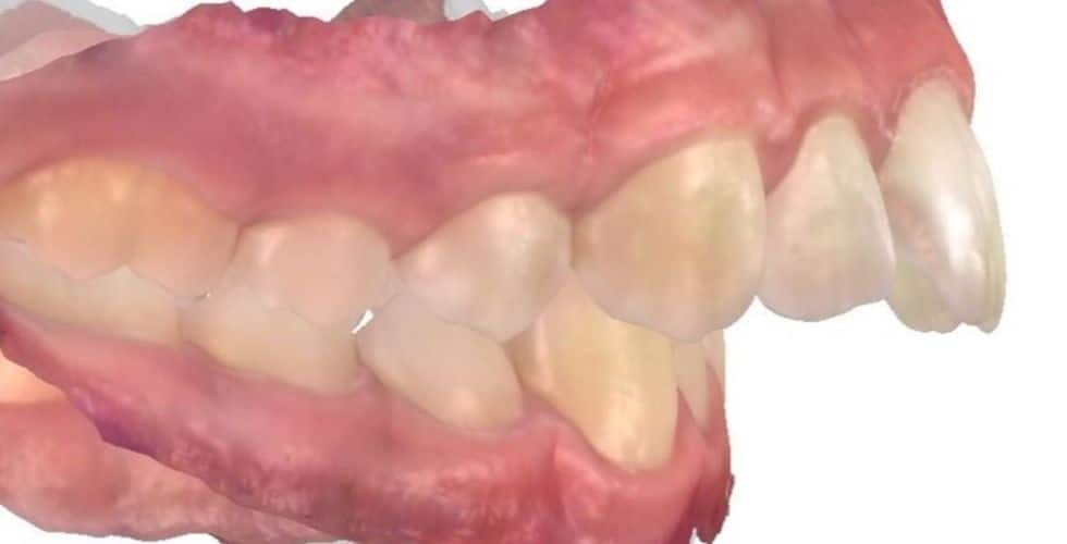 Smile gallery 142 C. S. Buccal before view orthodontic treatment